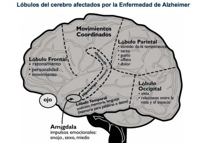 cerebro afectado Alzheimer y ejercicio físico