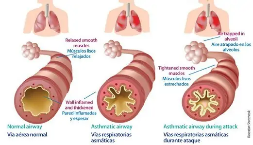 Asma y actividad física