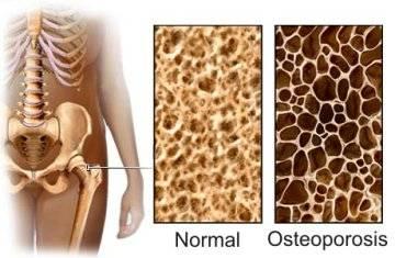 Comparación de un hueso normal y un hueso con osteoporosis.