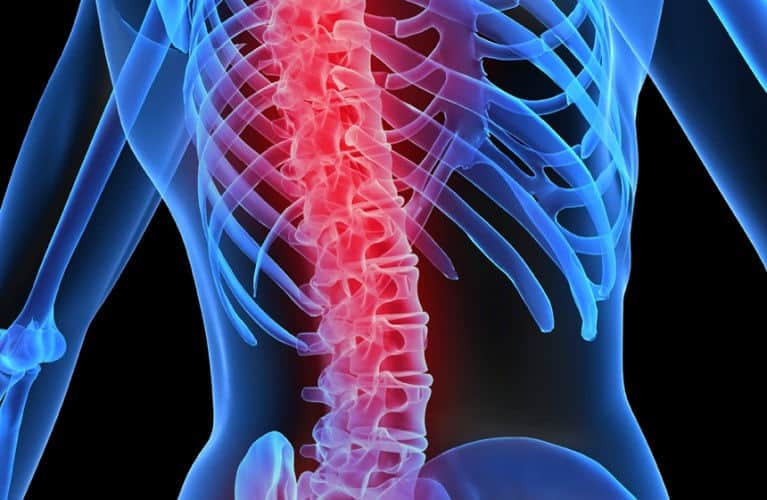 Osteoporosis en espalda