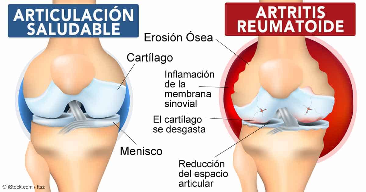 Artritis reumatoide y articulacion