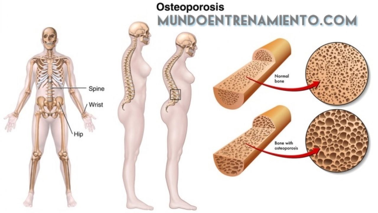 sintomas de la enfermedad osteoporosis