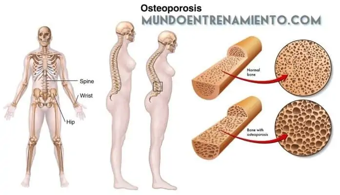osteoporosis y ejercicio