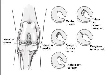 Tipos de roturas de meniscos de la rodilla