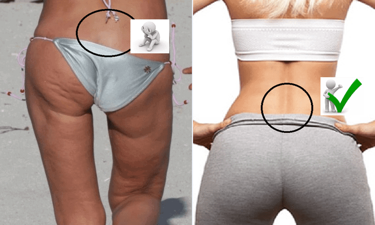 Erectores espinales. A la izquierda, práctica inexistencia del desarrollo de los erectores espinales inferiores (además de glúteos mayor y medio) y a la derecha, visible desarrollo de ambos. 