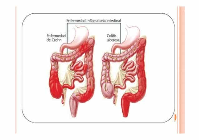 Diferencias entre Enfermedad de Crohn y Colitis Ulcerosa