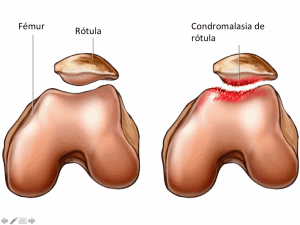 Imagen 1. Condromalacia rotuliana. 