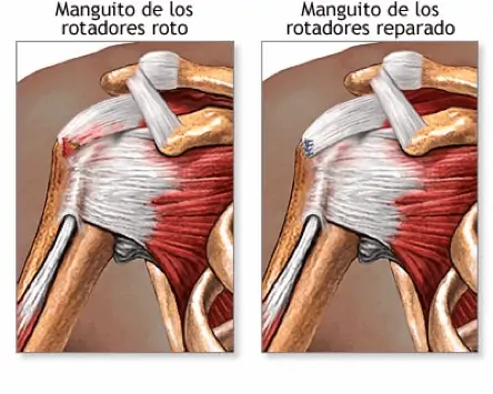 Figura 3. Lesión y recuperación del manguito rotador.