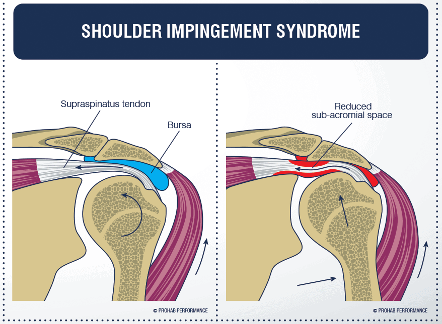 Síndrome impingement