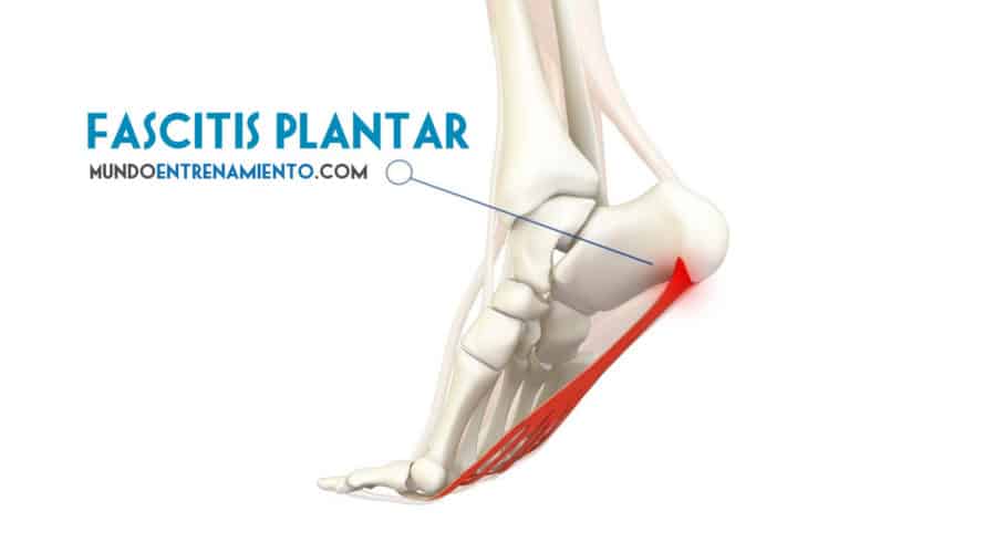 Fascitis plantar: causas y tratamiento 1 fascitis plantar