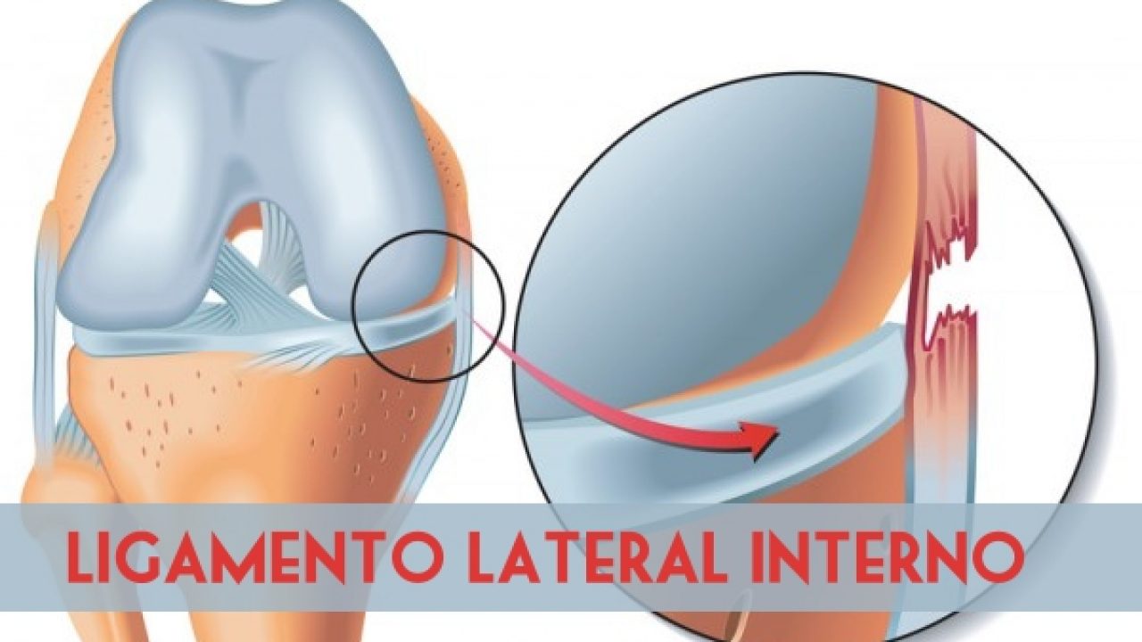 Lesión en el Ligamento Lateral Interno de la Rodilla