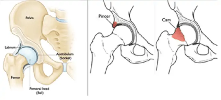 A la derecha, la articulación coxo-femoral, con las distintas estructuras que la forman. A la izquierda, podemos ver los 2 tipos de conflictos que se pueden producir en la cadera, Tipo Cam o tipo Pincer.