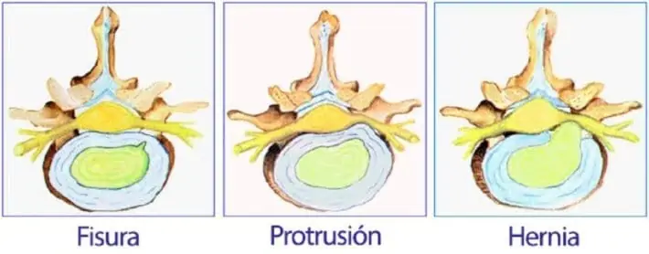 ejemplo protusión en una hernia de disco en la zona lumbar