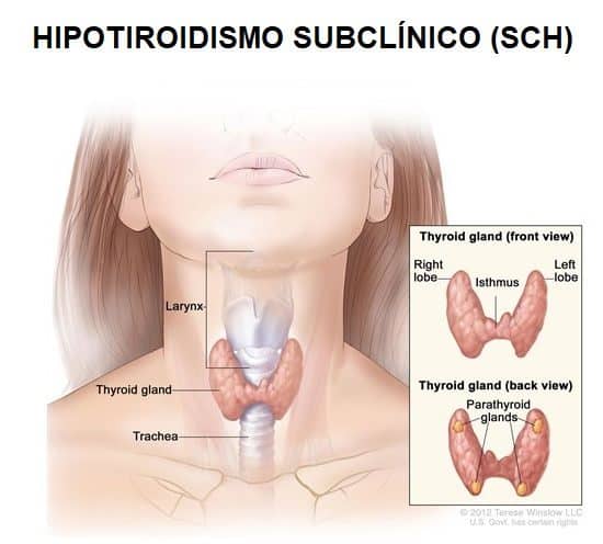 hipotiroidismo subclínico autoinmune o enfermedad de Hashimoto