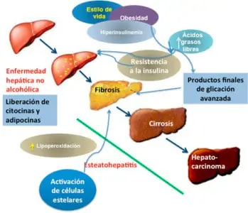 Factores que influyen en el padecimiento de hígado graso no alcohólico.