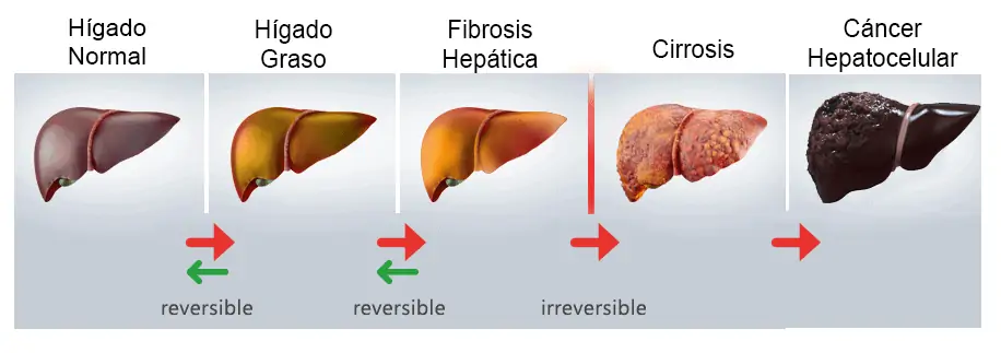 estados característicos de un hígado graso no alcohólico.