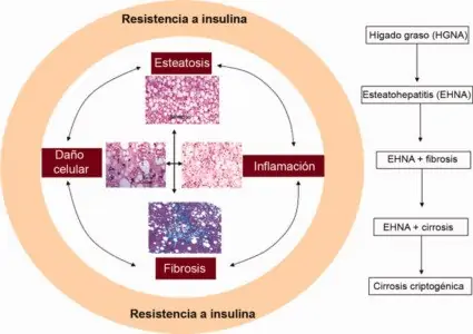 La resistencia a la insulina como un factor de importancia en personas con hígado graso