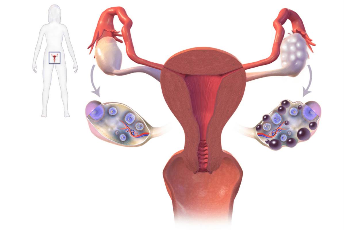 Síndrome del Ovario Poliquístico