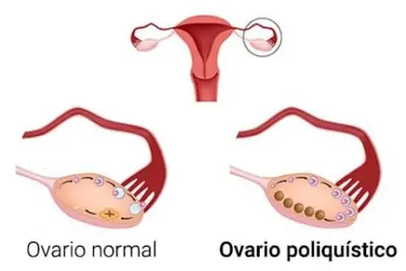 ovario poliquistico vs ovario normal
