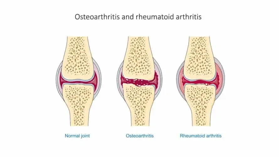 Articulación sana, con artrosis y con artritis