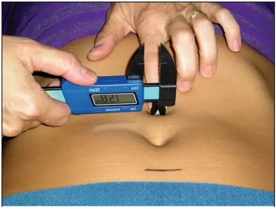 Calibrador para medir diástasis abdominal