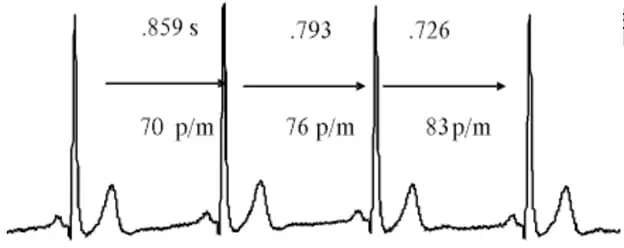 VFC en segundos (s) y su posterior cálculo de los látidos por minuto (p/m)