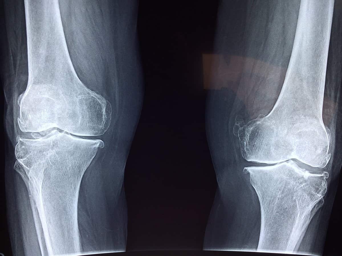 Radiografía de rodillas