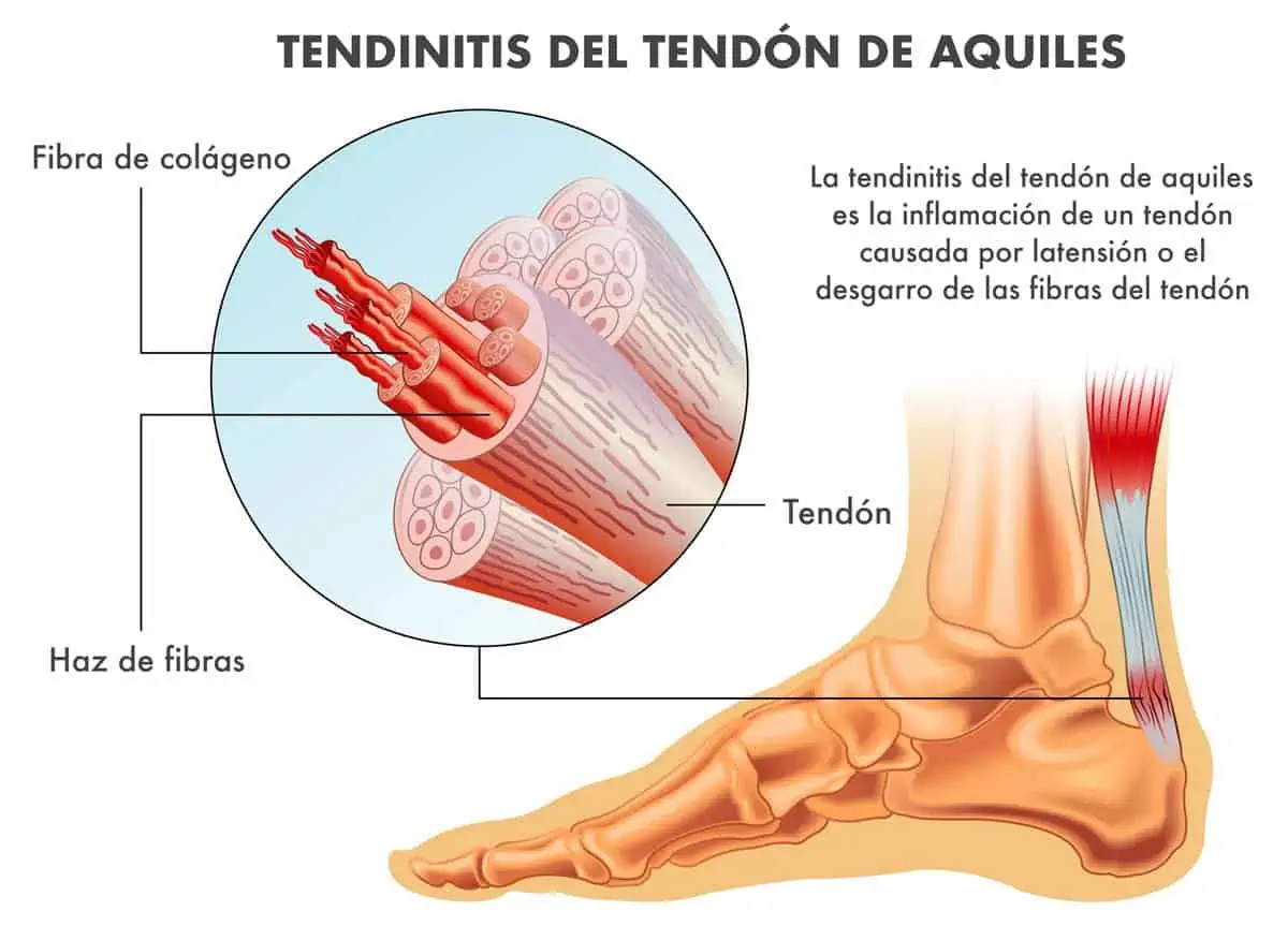 tendinitis del tendón de aquiles