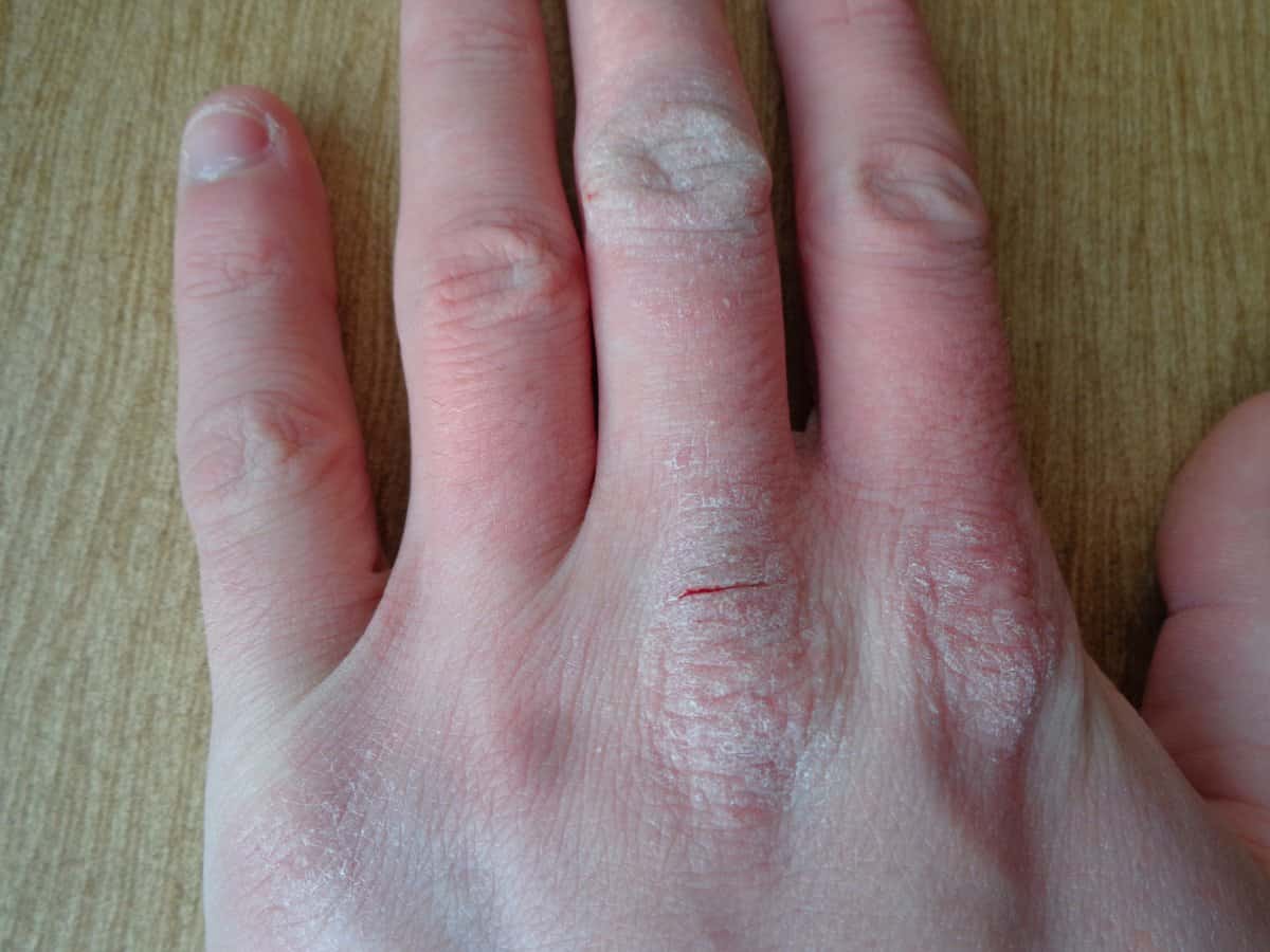 dermatitis atópica