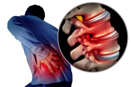Cuadrado lumbar: anatomía, dolor y estiramientos clave estenosis lumbar