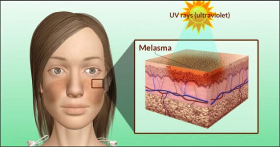 melasma