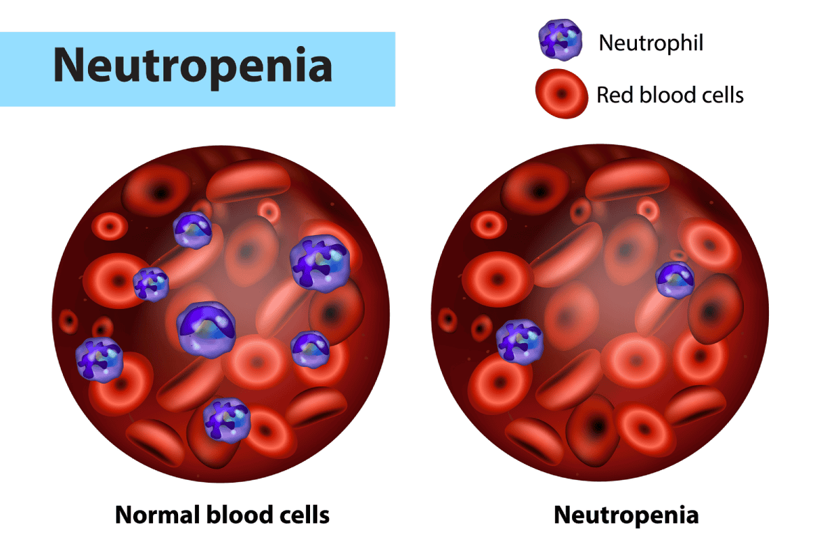 neutropenia