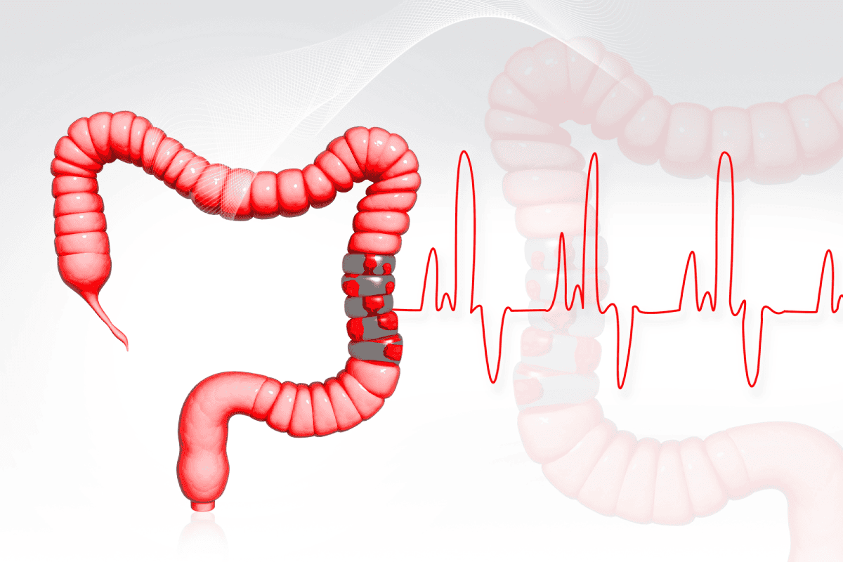 cáncer de colon