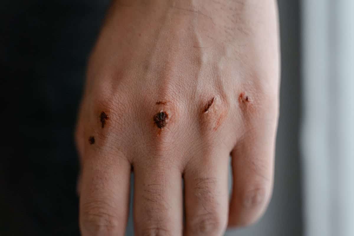 heridas en la piel