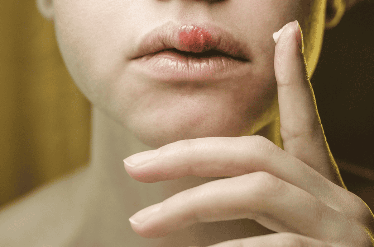 Mujer aplicando corticosteroides en su labio superior