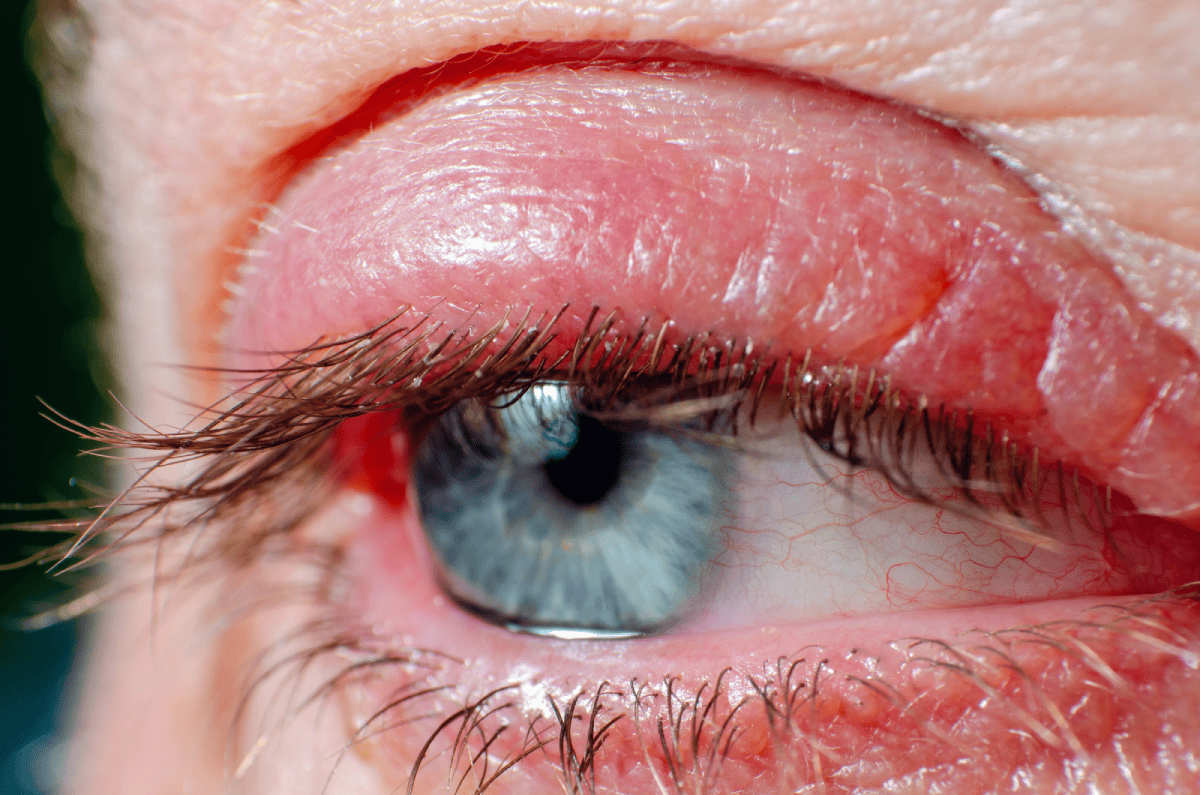 ojo irritado por blefaritis