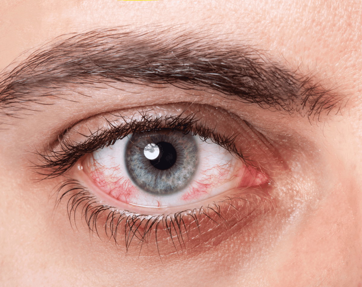 acumulación de sangre en el ojo