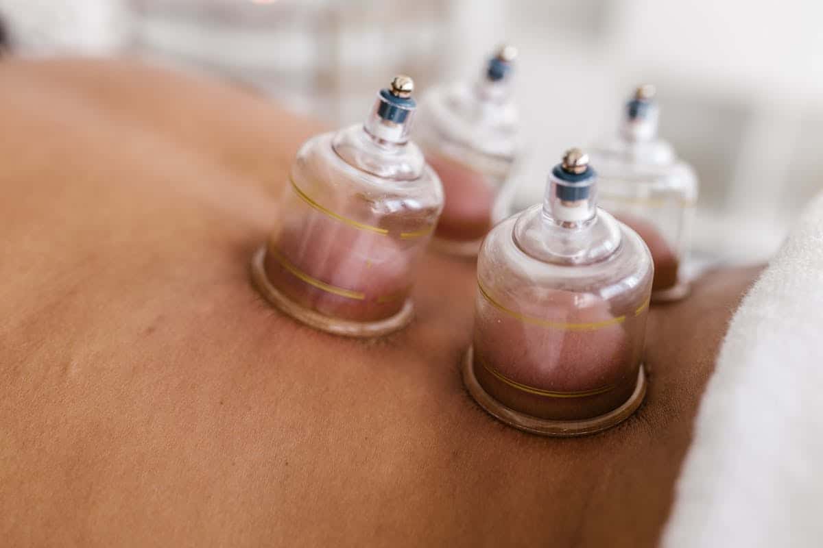 terapia con ventosas
