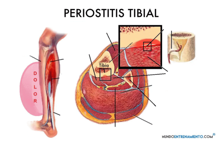 Periostitis tibial