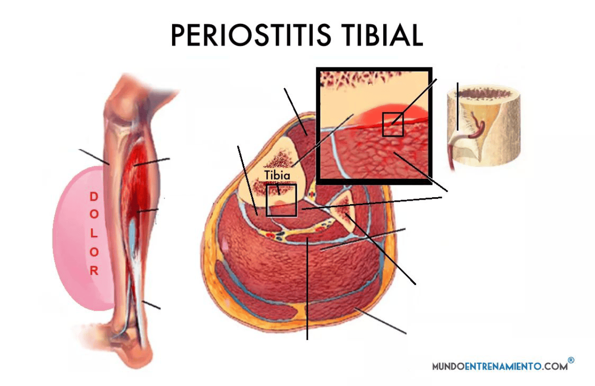 Periostitis tibial