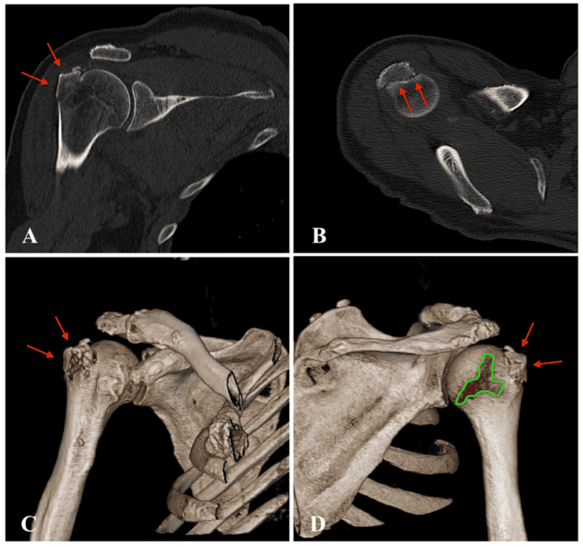 Hombro dislocado: síntomas, causas y tratamientos TAC luxación hombro