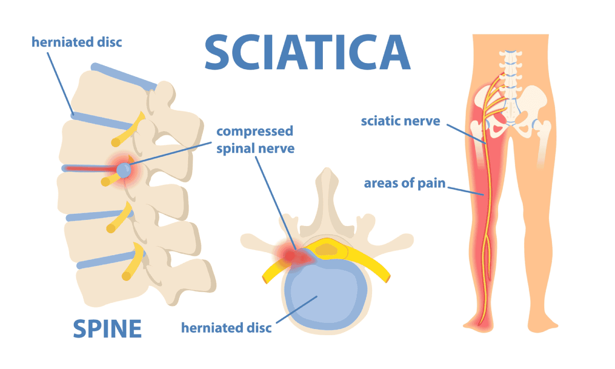 Pinzamiento lumbar: qué es, síntomas y tratamiento Pinzamiento radicular o ciática
