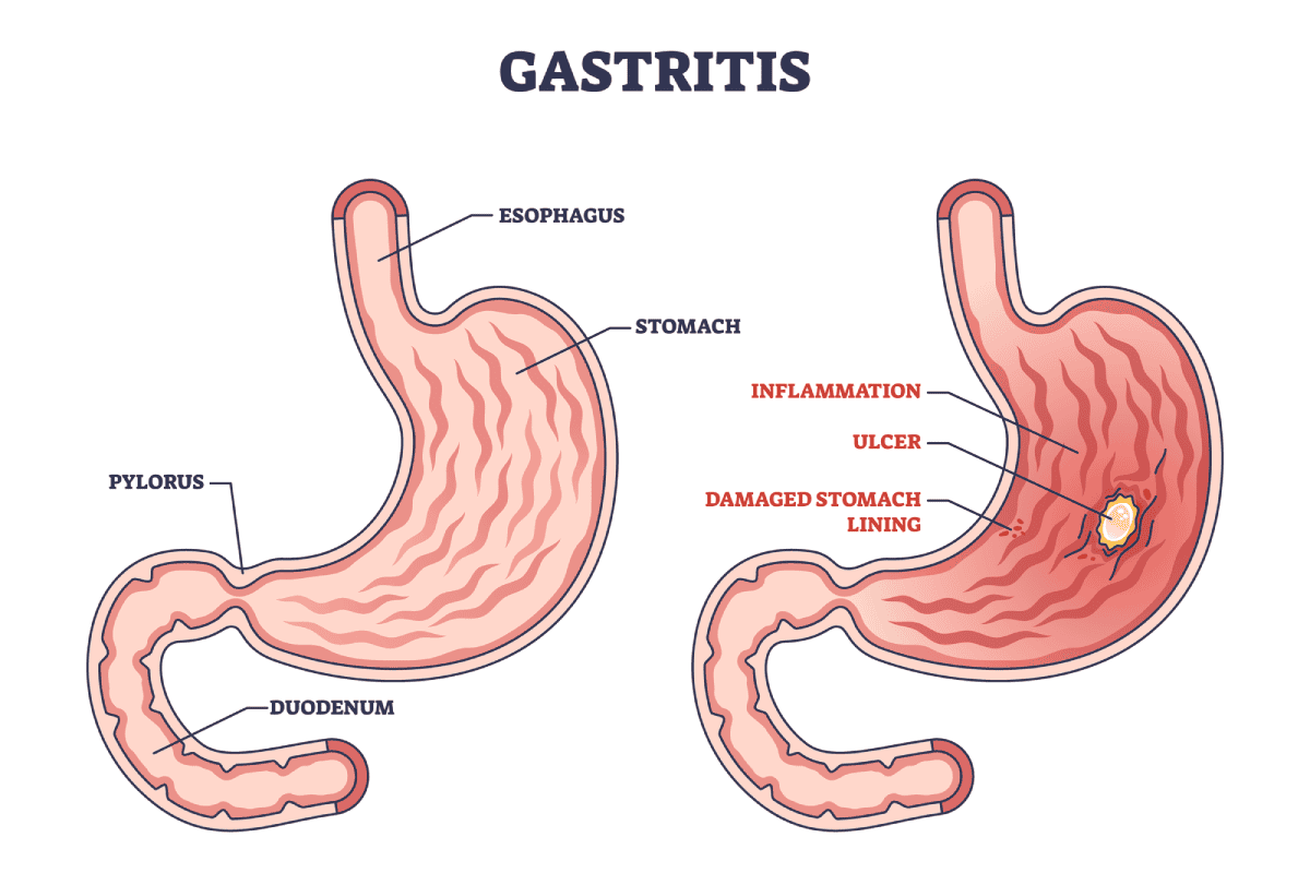 Gastritis crónica: síntomas principales y tratamiento Tipos gastritis